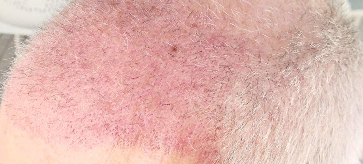 La importancia de escuchar la piel y el cabello en una cirugía capilar en integria