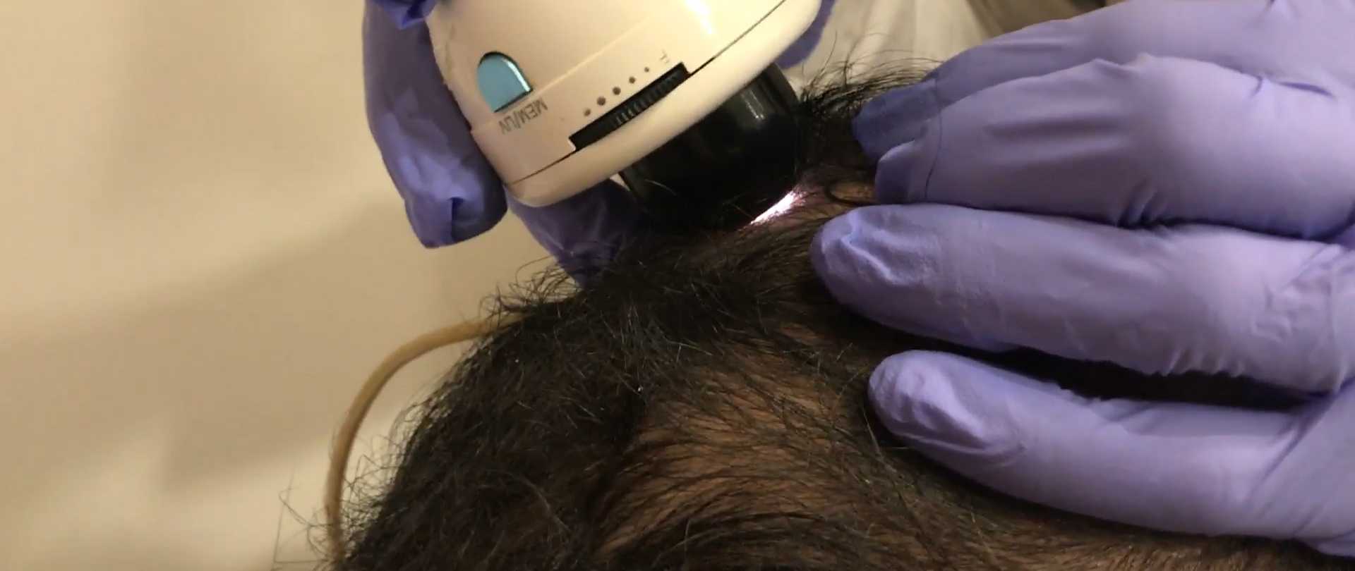 Injerto capilar en granada