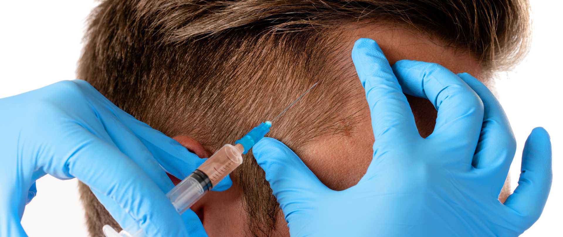 Injerto Capilar y Trilogía en Granada